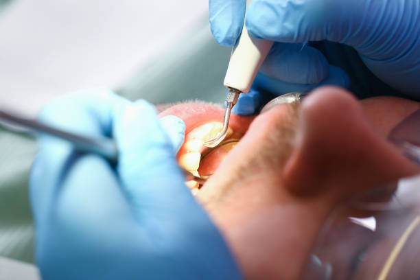 Best Emergency Tooth Extraction in Badin, NC